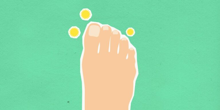 Foot infection from excessive sweating